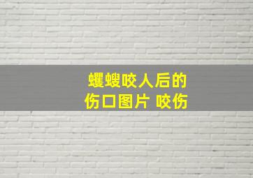 蠼螋咬人后的伤口图片 咬伤